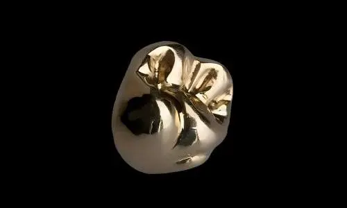 Why Are Full Cast Metal Crowns Used for High-Load Posterior Restorations?